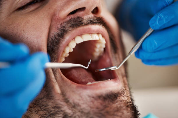 Best Chipped Tooth Repair Near Me  in Shell Kno, MO